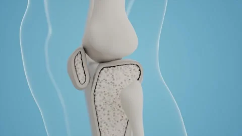 Osteoporotic bone density 库存影片 313832185