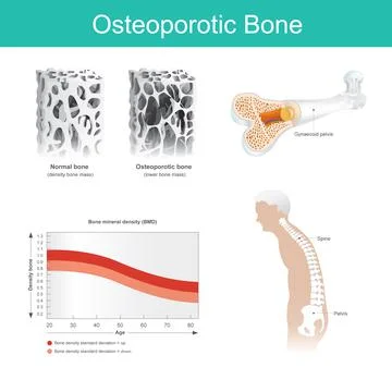 Osteoporotic bone. This is a disease in which the density and quality of bone Stock Illustration