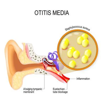 Otitis media and Staphylococcus aureus Stock Illustration