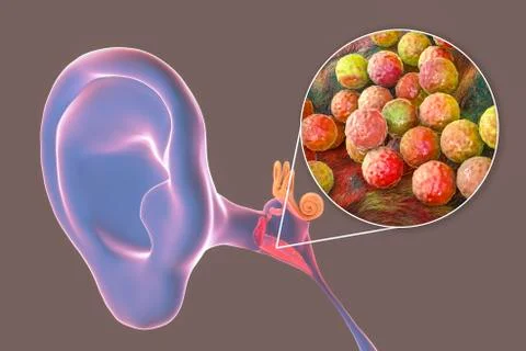 Otitis media, inflammatory disease of the middle ear Stock Illustration