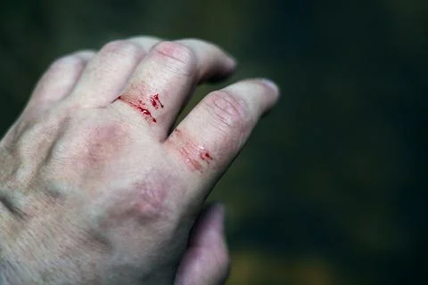 Outer part of a human hand with visible injuries and small blood droplets, .. Foto stock