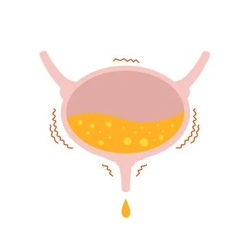 Overactive bladder. Urinal overflow. Illustrazione stock