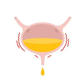 Overactive bladder. Urinal overflow イラスト素材