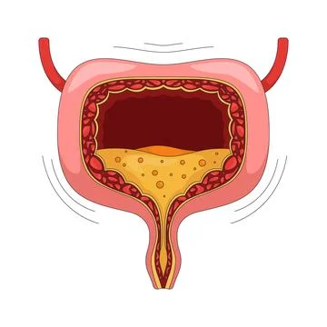 Overactive human bladder with urgency symptom 2D vector illustration Illustrazione stock