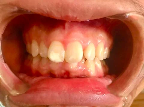 Overbite Teeth with Lips Foto stock