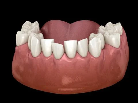 Overcrowded teeth, abnormal dental occlusion Stockillustratie