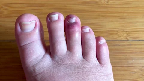 Overhead shot of a Woman's Jammed, Sprained and Bruised Toe Stock Footage 220032883