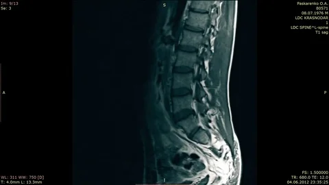 Overview Hernia of a Backbone of Lumbar Department by MRT Method Video stock 71410653