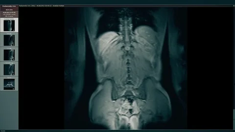 Overview Hernia of a Backbone of Lumbar Department by MRT Method Stock Footage