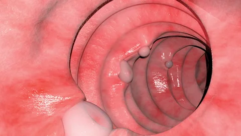 Overview of the Intestinal Polyps Stock-Footage 140060162