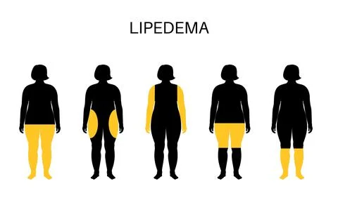 Overweight problem concept Stock Illustration