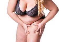 Overweight woman with fat cellulite legs and belly, obesity female