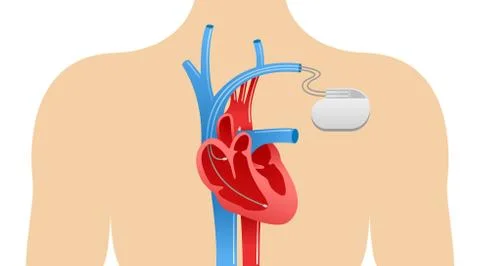 Pacemaker anatomical scheme Stock Illustration