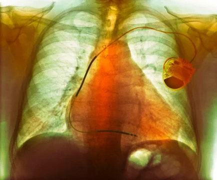 Pacemaker in heart disease, X-ray 스톡 사진