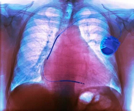Pacemaker in heart disease, X-ray 스톡 사진