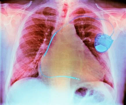 Pacemaker in heart disease, X-ray 스톡 사진