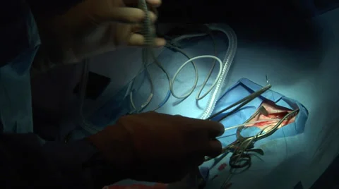 Pacemaker Insertion Surgery Stock Footage 33990774