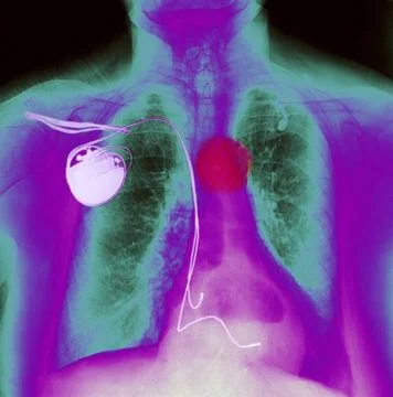  Pacemaker Patient wearing a pacemaker, and affected by a hiatal hernia. C... Stock Photos