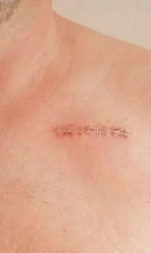 Pacemaker scar Stock Photos