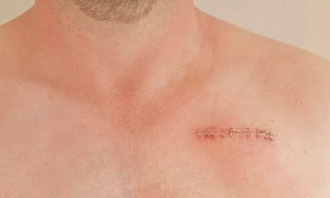 Pacemaker scar 스톡 사진