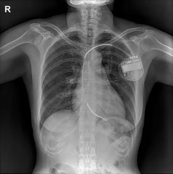 Pacemaker showing in chest x-ray Stock Photos