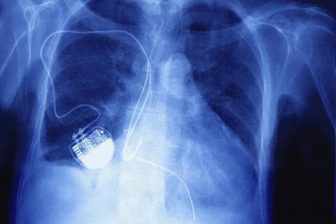  Pacemaker X-ray, frontal view. Copyright: xCAVALLINIxJAMESx/xBSIPx 003354... Stock Photos