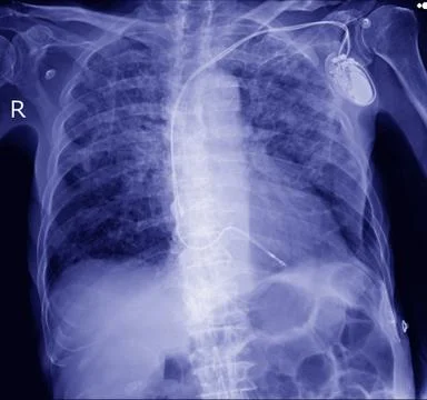 Pacemaker in x-ray image in cardiac catheterization laboratory Stock Photos