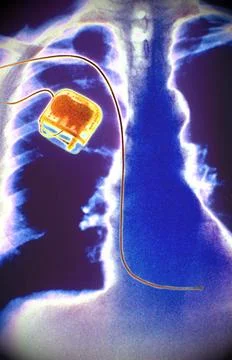  Pacemaker X-ray of pacemaker. Copyright: xSGOx/xIMAGExPOINTxFRx/xBSIPx 00... Stock Photos