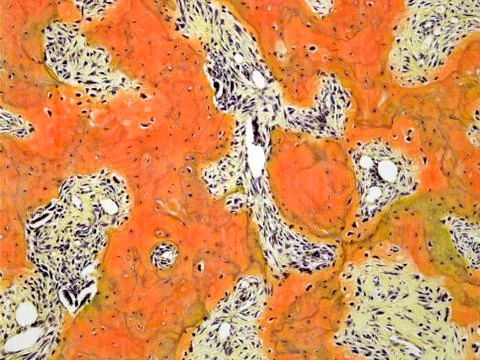 Paget's disease, light micrograph Stock Photos