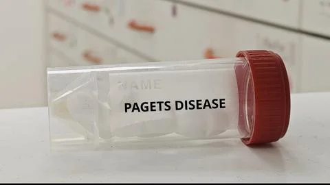 PAGETS DISEASE treatment tablets for regulate abnormal bone remodeling 스톡 사진