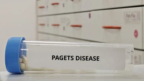 PAGETS DISEASE treatment tablets for regulate abnormal bone remodeling 스톡 사진