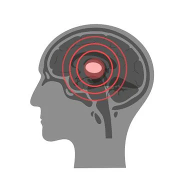 Pain Brain Illustration 库存插图