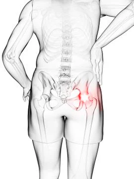Painful hip joint, artwork Stock Illustration