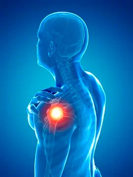 Painful shoulder, artwork Stock Illustration