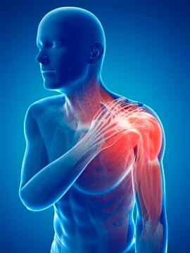 Painful shoulder, artwork Stock Illustration