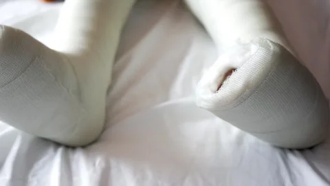 A pair of white plaster casts on child's legs slowly move on a white sheet. Stock Footage 332578805