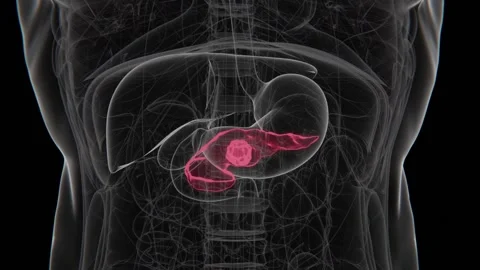 Pancreatic cancer is a malignant tumor that develops in the pancreas, an organ Stock Footage 345125531