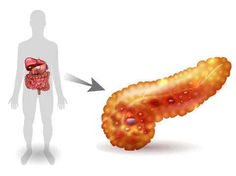 Pancreatitis illustration Stock Illustration