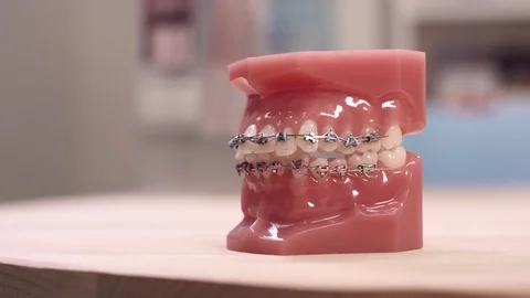 Panning across model of braces on teeth sitting on counter top 動画素材 113726668