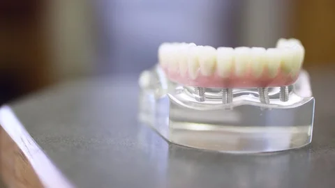 Panning model of teeth being held in place by dental implants Video stock 113728213