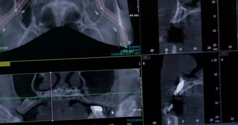 Panoramic 3D x-ray of a human jaw on a computer screen. Stock Footage 233257651