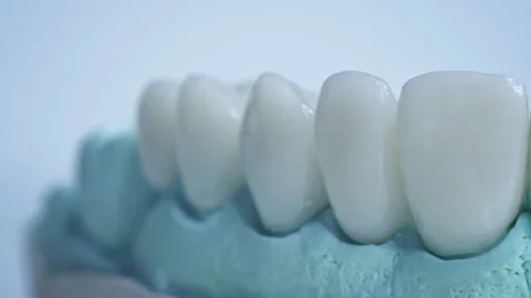 Panoramic close up view of dental implants in jaw with blue background. New Video stock 135972231
