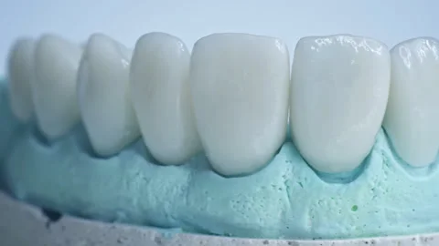 Panoramic close up view of dental implants in jaw with blue background. New Stock Footage 135972260