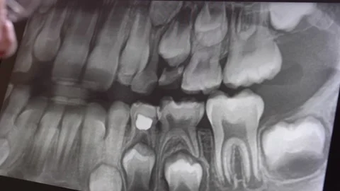 Panoramic Dental X-Ray Image Examined by Male Dentist in Protective Glasses Stock Footage