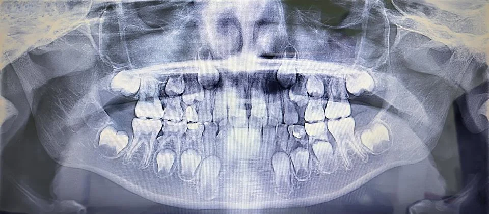 Panoramic dental x-ray image revealing teeth and jaw structure Stock Photos