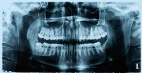 Panoramic dental x-ray Stock Photos