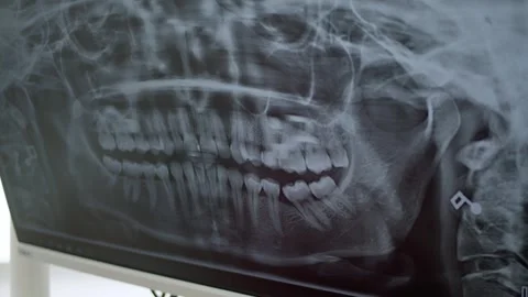 Panoramic dental x-rays at the dentist's office. Stock Footage 255226540