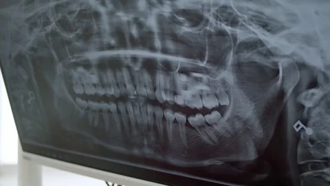 Panoramic dental x-rays at the dentist's office. Stock Footage 255226558
