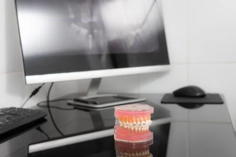 Panoramic x-ray on computer screen. Model of the jaw on the table Stock Photos