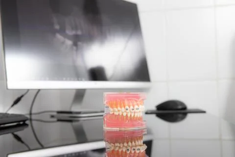 Panoramic x-ray on computer screen. Model of the jaw on the table Stock Photos